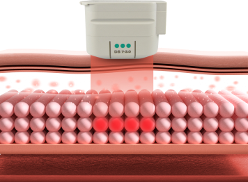 How Prime Ultherapy Works